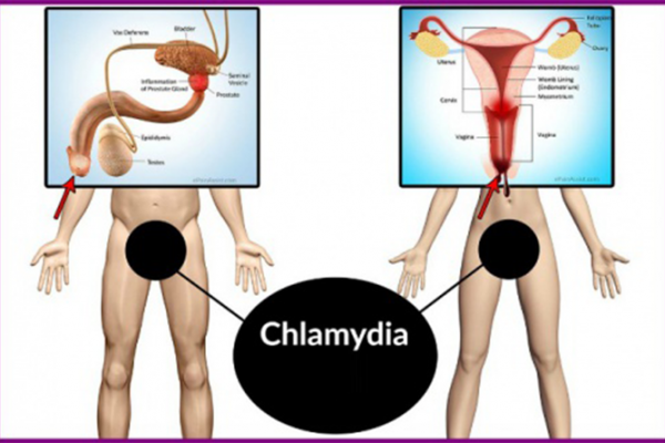 Những điều cần biết về bệnh Chlamydia