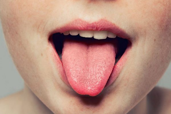 Sùi mào gà ở lưỡi: nguyên nhân và cách điều trị